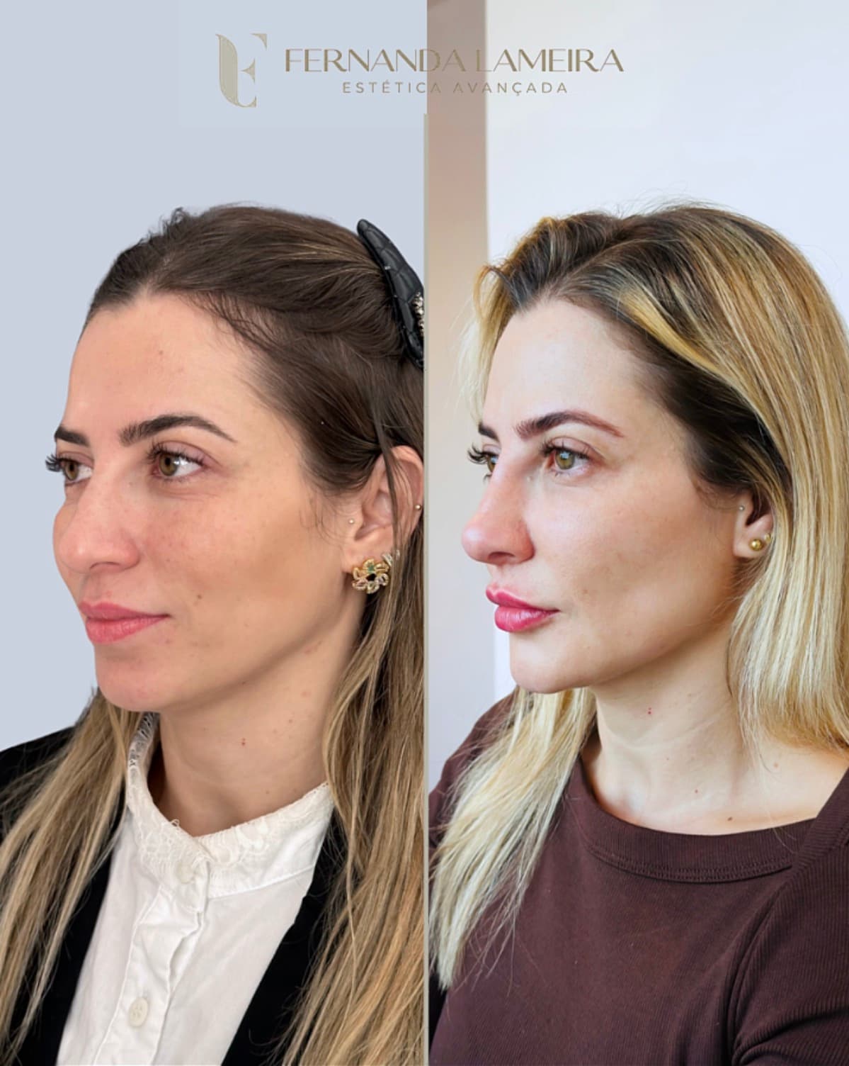 Resultado harmonização facial BH 11