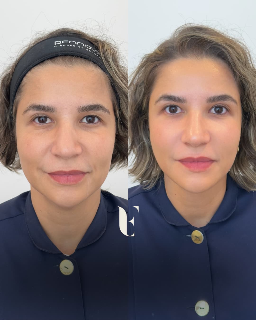 Resultado harmonização facial BH 2