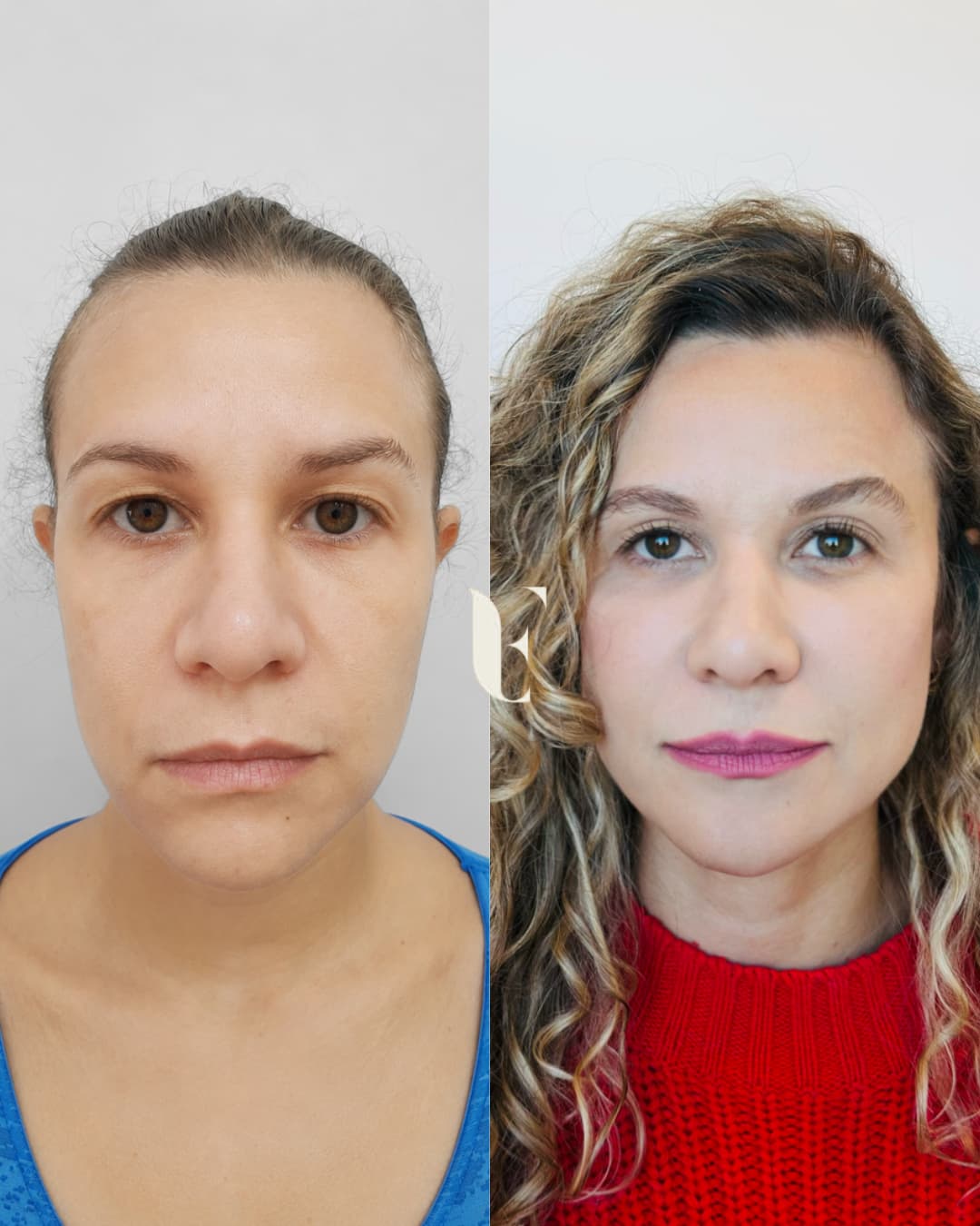 Resultado harmonização facial BH 4
